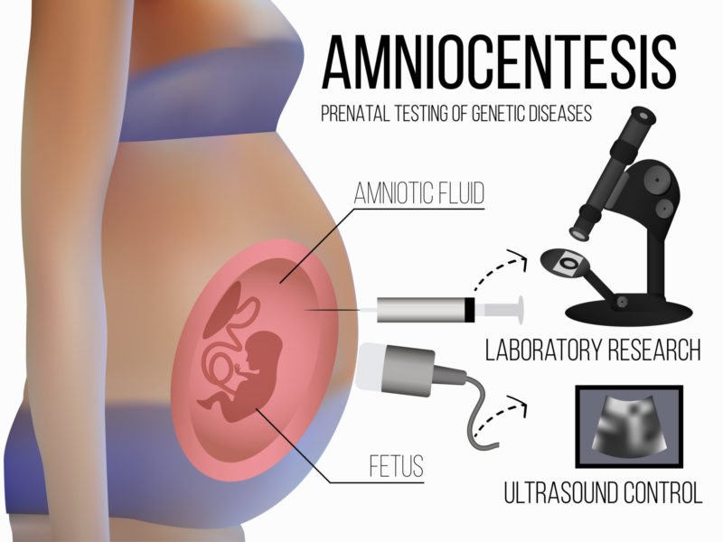 photo showing how amniocentesis works for genetic testing for pregnancy